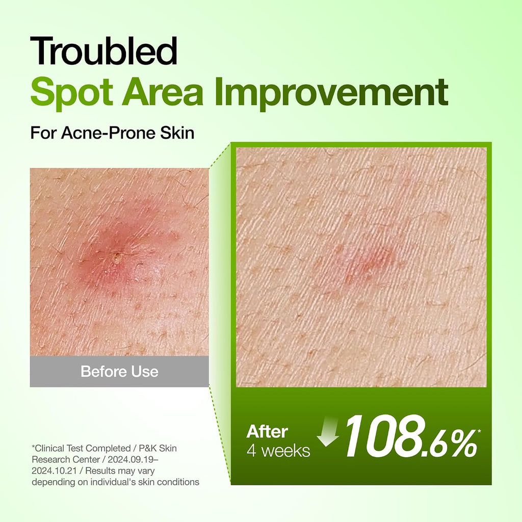Anua Azelaic Acid 10 Hyaluron Redness Soothing Serum. 1.01 fl oz | Facial Serum for Blemish-Prone & Oily-Prone Skin. Lightweight & Hydrating Blemish Care. Hyaluronic Acid. Korean Skincare